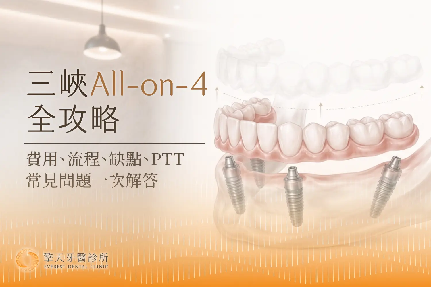 All-on-4 原理、優缺點、費用與流程一次了解