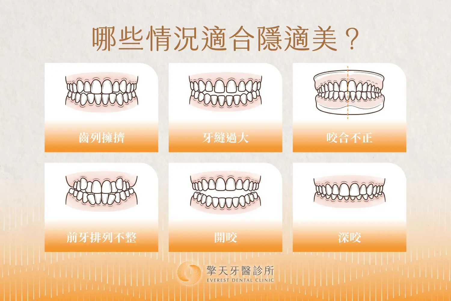 適合隱適美的牙齒問題:齒列擁擠、牙縫過大、咬合不正、前牙排列不整、開咬、深咬