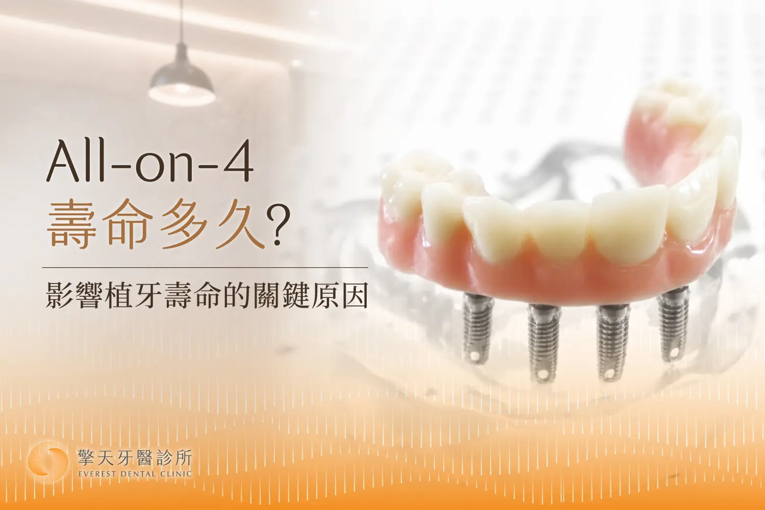 All on 4壽命多久?影響植牙壽命的關鍵原因